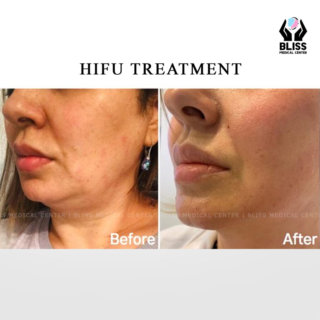 Before and after image of Ultraformer HIFU Treatment in Ajman
