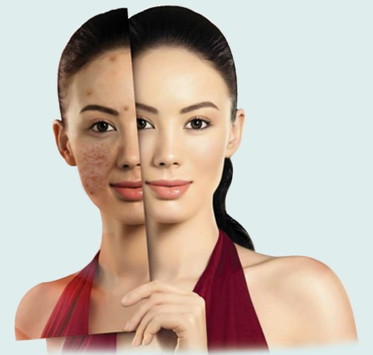 Woman showing clear skin after acne scar treatment