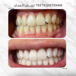 Theeth Whitening