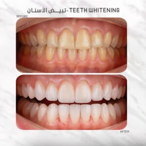 Theeth Whitening2