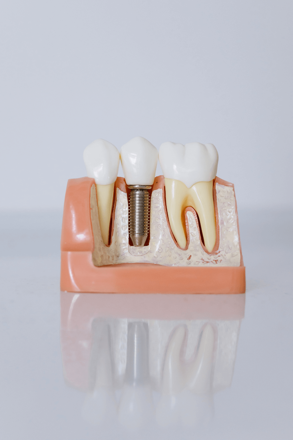 Close-up model showing dental implant structure and tooth replacement at Bliss Medical Center in Ajman