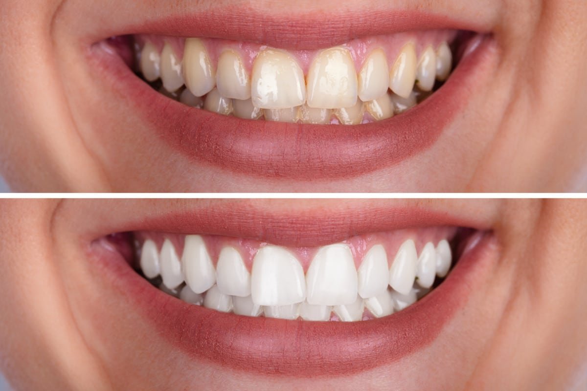 beyond teeth whitening offer