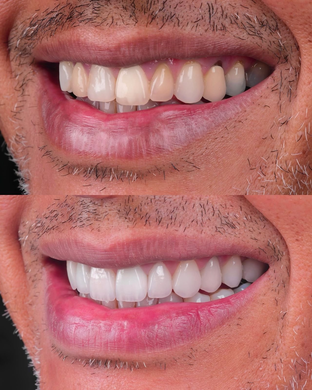 Hollywood Smile before and after result 2