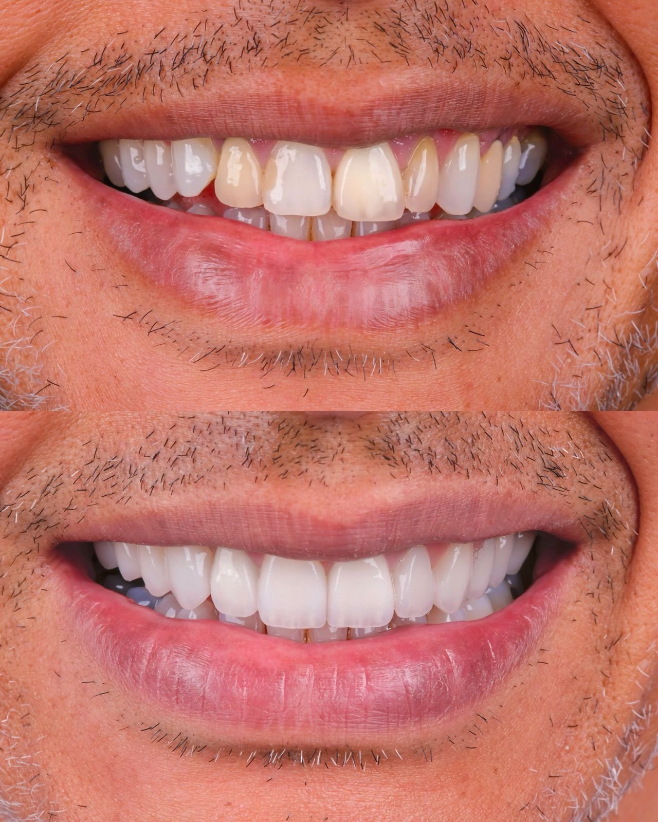 Hollywood Smile before and after result 4