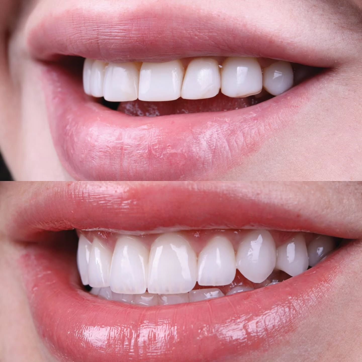 Hollywood Smile before and after result 1