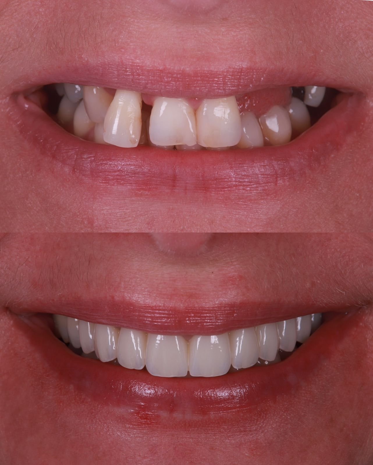 Dental patient smile result 1