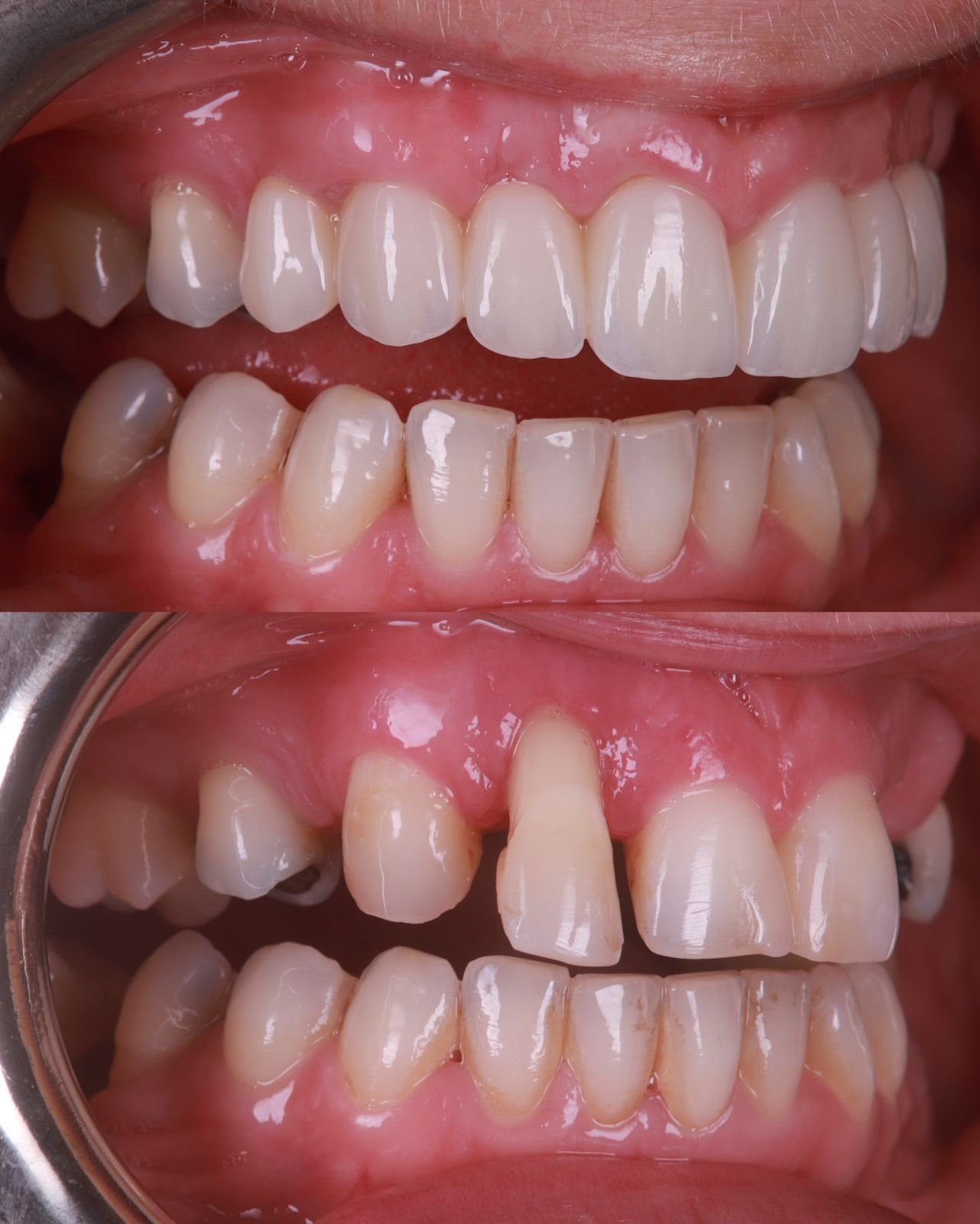 Dental patient smile result 3