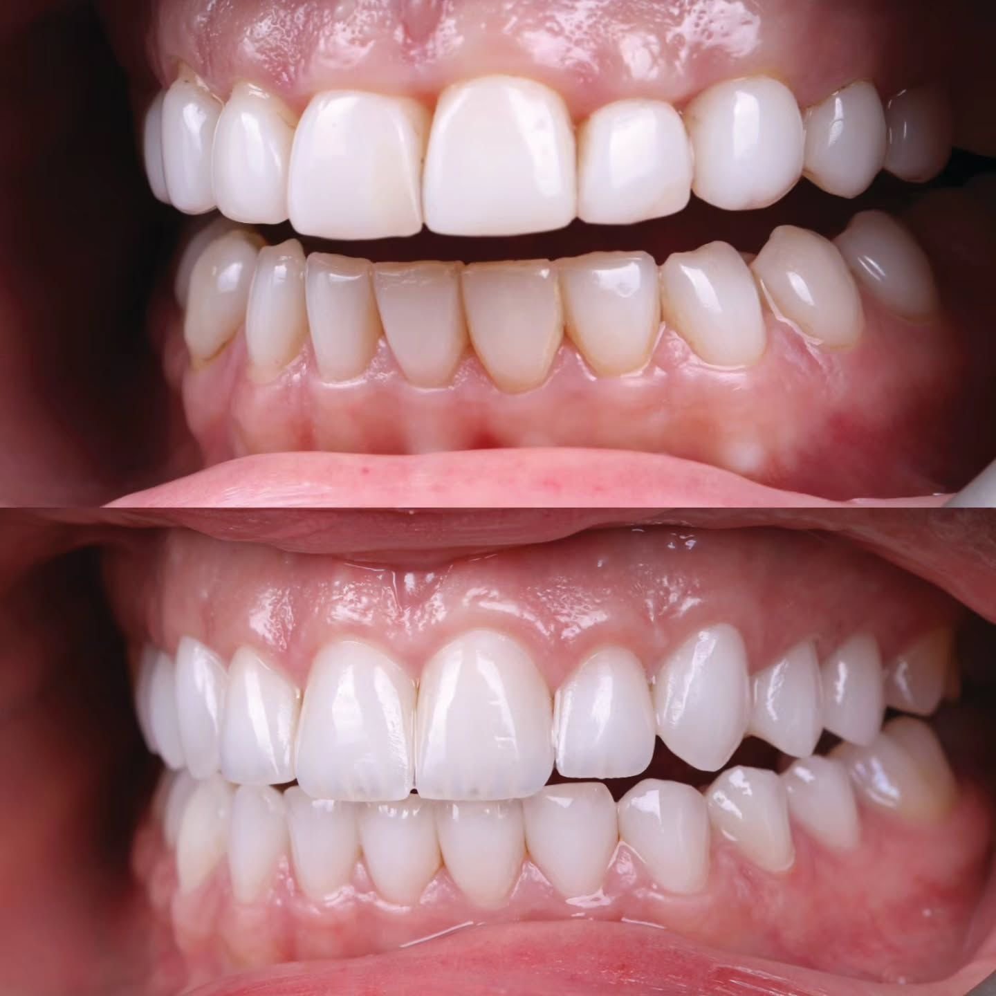 Hollywood Smile before and after result 3